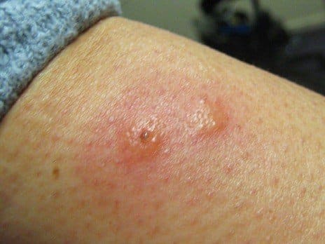 Caseros contra las picaduras de pulgas